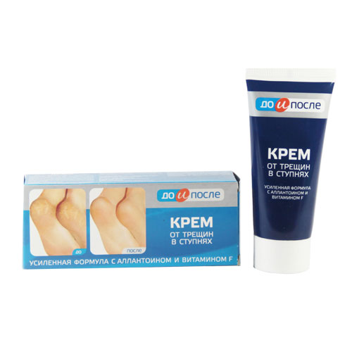 Kem trị nứt, nẻ gót chân Kpem Nga