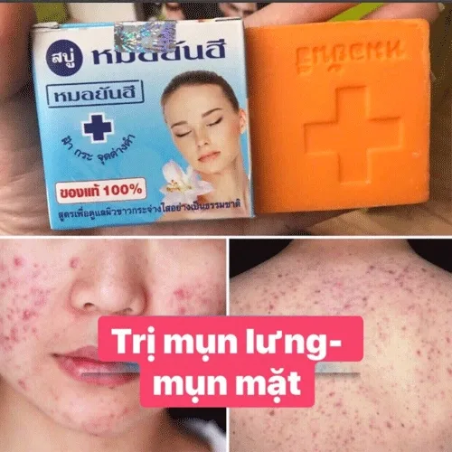 Soáp Trị Mụn Yanhee Thái Lan